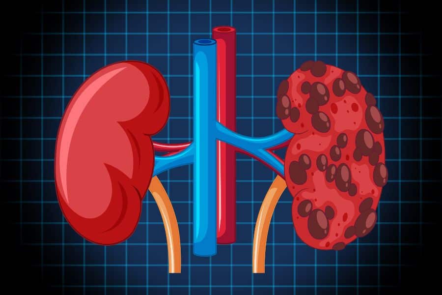 Top Kidney Stone Causes Explained: Steps to Stay Healthy