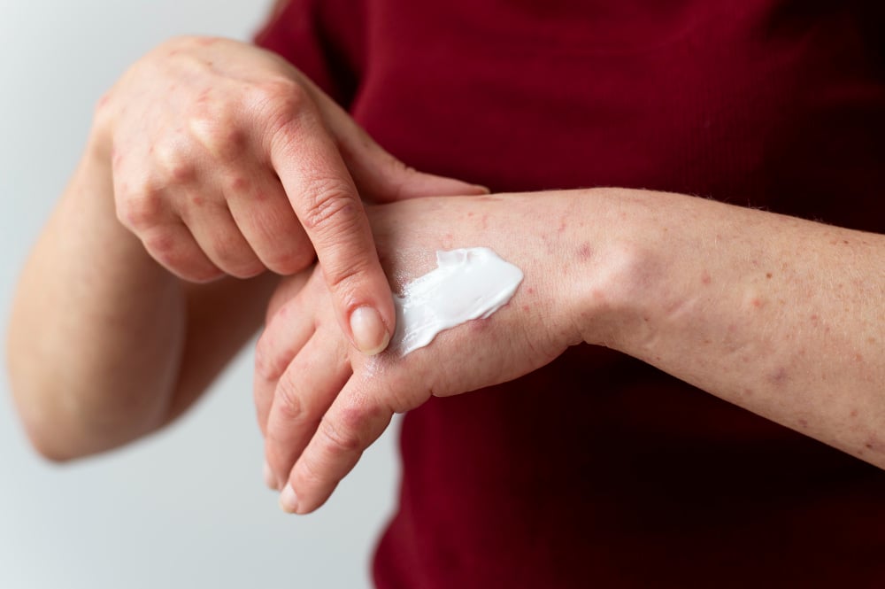 How to Treat Skin Rashes Due to Allergy with Homeopathy