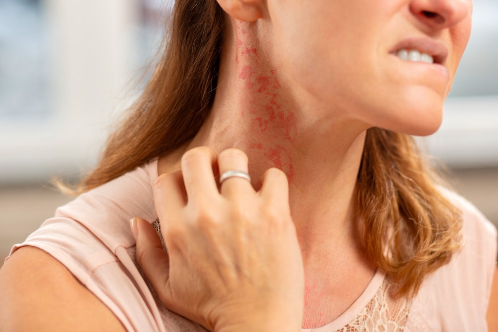 Treat Skin Rashes Due to Allergy with Homeopathy and Holistic Care