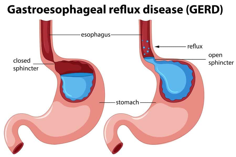 Understanding GERD: Causes, Symptoms, and Prevention